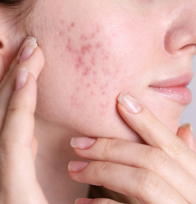 Acne Treatment Image